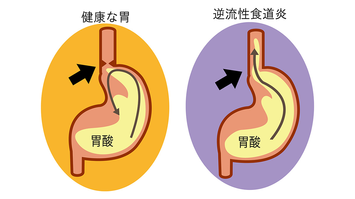 守護全家人的食道！搞懂「胃酸逆流」真相　